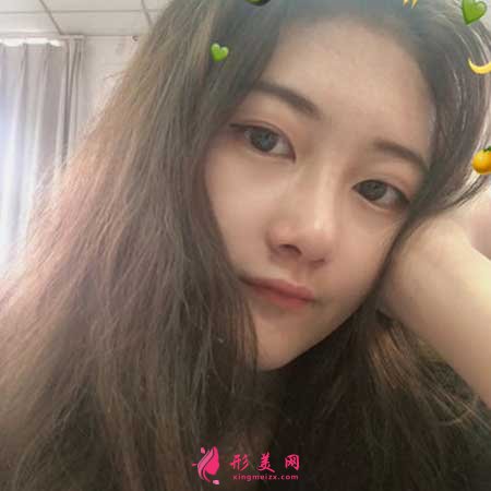 找南京黃金龍醫(yī)生做了隆鼻手術(shù)后，鼻子俊俏好看