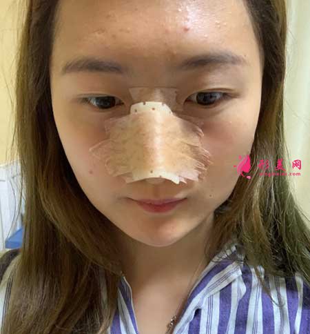 找南京黃金龍醫(yī)生做了隆鼻手術(shù)后，鼻子俊俏好看