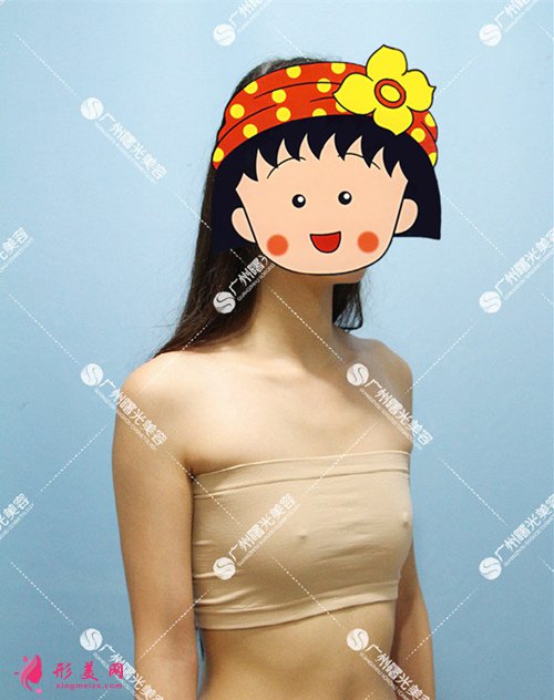 廣州曙光整形醫(yī)院隆胸好不好