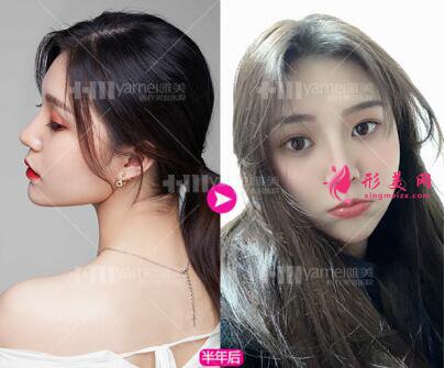 長(zhǎng)沙雅美田芳斌做的鼻綜合