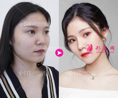 長(zhǎng)沙雅美田芳斌做的鼻綜合