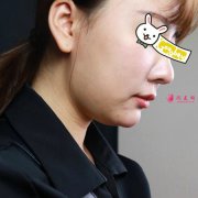 想變小V臉，就去北京純脂整形醫(yī)院-專注脂肪整形