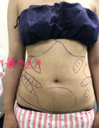 北京純脂整形醫(yī)院全身吸脂案例 腰圍從78變成60啦