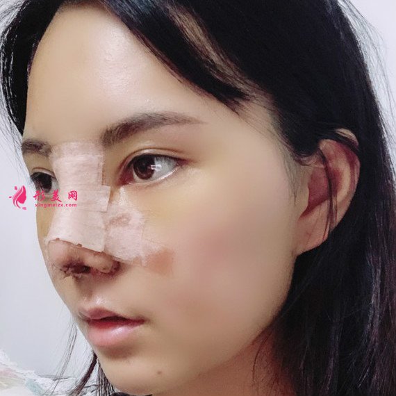 女人無(wú)需傾國(guó)傾城的整形術(shù)后圖片