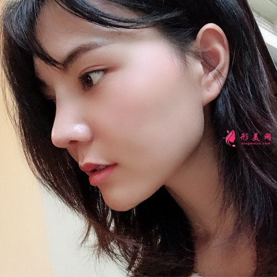 女人無(wú)需傾國(guó)傾城的整形術(shù)后圖片