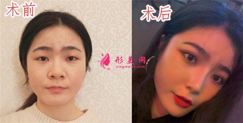 南京美貝爾整形醫(yī)院切開(kāi)雙眼皮案例