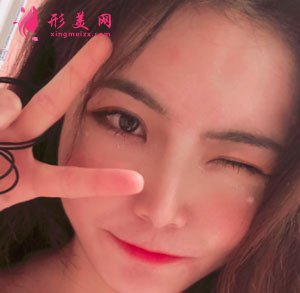 南京美貝爾整形醫(yī)院切開(kāi)雙眼皮案例