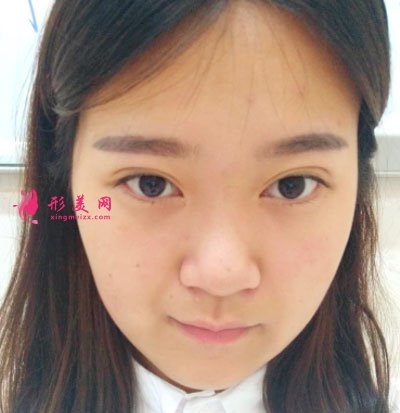 鄭州締萊美醫(yī)療美容醫(yī)院鼻部多項(xiàng)案例