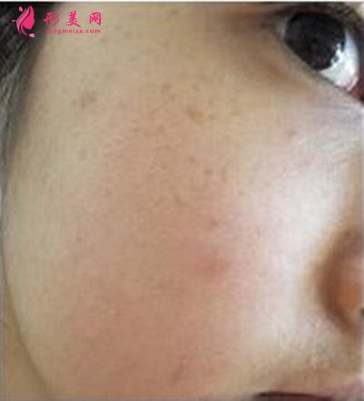 北京水光針皮膚管理效果分享