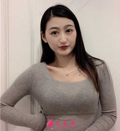 去廣州曙光整形美容醫(yī)院做假體隆胸手術(shù)后8天