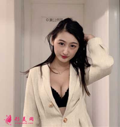 去廣州曙光整形美容醫(yī)院做假體隆胸手術(shù)后兩個月