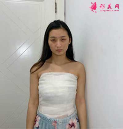 去廣州曙光整形美容醫(yī)院做假體隆胸手術(shù)后3天