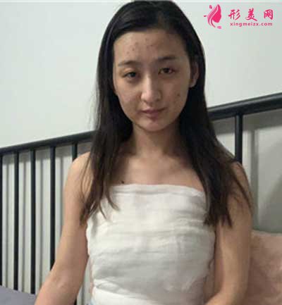 去廣州曙光整形美容醫(yī)院做假體隆胸手術(shù)后1天