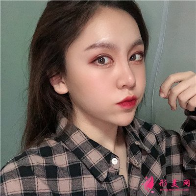 成都小姐姐的鼻綜合手術(shù)術(shù)后效果分享圖