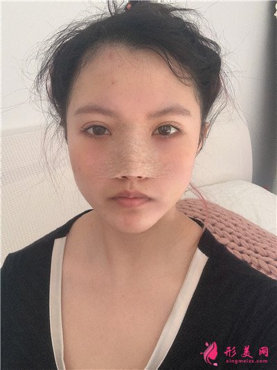 深圳耳軟骨隆鼻術后恢復情況對比案例分享