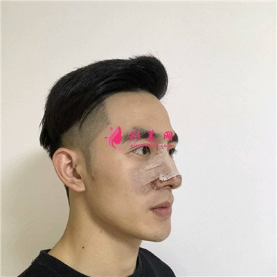 南京小哥哥鼻部修復(fù)術(shù)后效果反饋