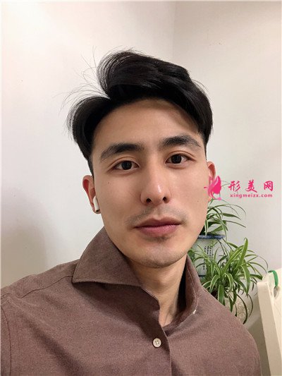 南京小哥哥鼻部修復(fù)術(shù)后效果反饋