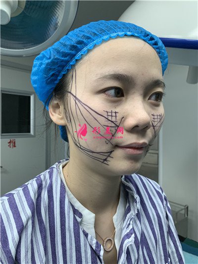 廣州小姐姐面部線雕提升術(shù)后效果對比