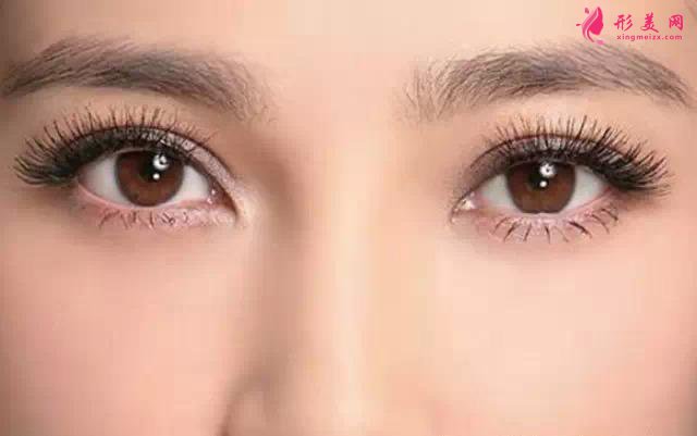 上瞼下垂矯正術(shù)后眼皮太上了怎么辦