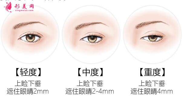 上瞼下垂矯正術(shù)后眼皮太上了怎么辦