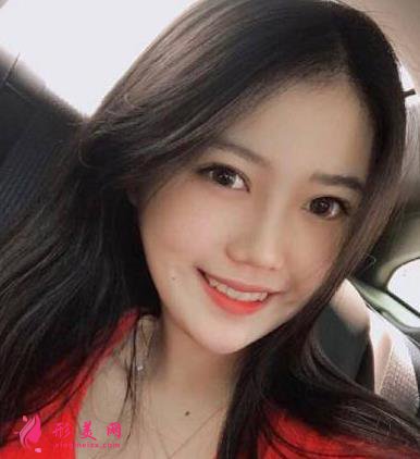 北京聯(lián)合麗格第一醫(yī)院雙眼皮案例分享！附2022價(jià)格表