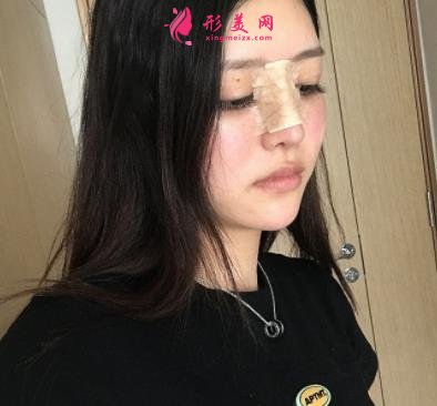 鄭大一附院整形科做鼻子怎么樣？醫(yī)生案例及價(jià)格價(jià)目表公開反饋