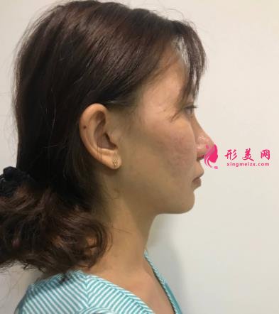 廣州廣大整形醫(yī)院面部輪廓價(jià)格價(jià)目表公開(kāi)!含實(shí)拍案例圖分享!