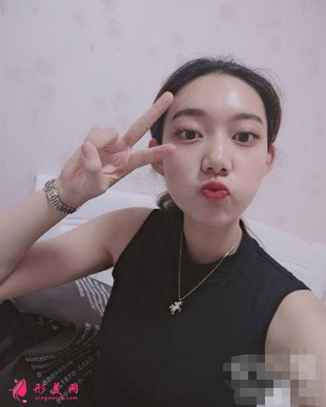 北京純脂孫澤芳面部填充脂肪案例反饋!整形價(jià)格全面一覽 北京純脂孫澤芳面部填充脂肪案例反饋!整形價(jià)格全面一覽