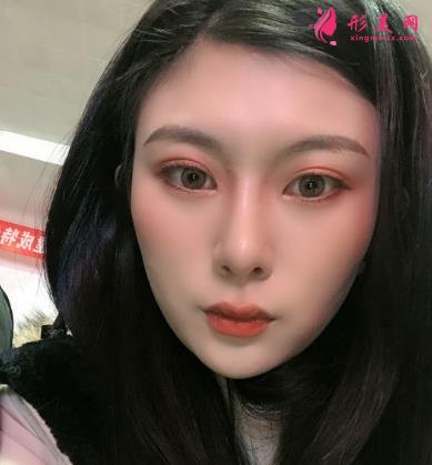 深圳陽光整形醫(yī)院雙眼皮怎么樣？效果好嗎？手術(shù)真實(shí)價(jià)格費(fèi)用參考