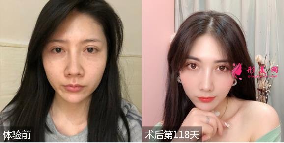 深圳富華醫(yī)院整形價格表一覽！有隆鼻效果為大家展示！