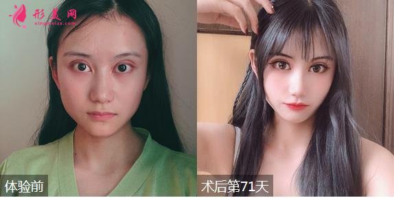 深圳富華醫(yī)院整形價格表一覽！有隆鼻效果為大家展示！